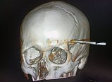 Нейрохирурги Солнечногорска прооперировали мужчину со стрелой в голове