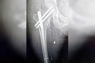 Врачи в Солнечногорске прооперировали 74-летнюю пенсионерку с переломом бедра
